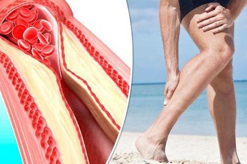 Chuột rút ở bắp chân, cảnh giác với xơ vữa động mạch ngoại biên