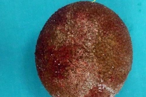 Phẫu thuật lấy viên sỏi bàng quang kích thước khổng lồ