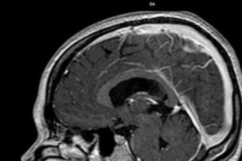 Bệnh viện Vũng Tàu điều trị kịp thời bệnh nhân bị tắc tĩnh mạch não
