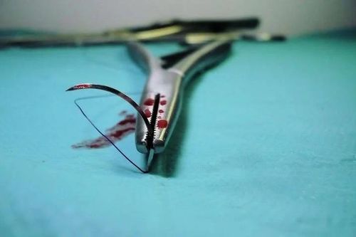 Sống với chiếc kim phẫu thuật bị bỏ quên trong bụng suốt 11 năm