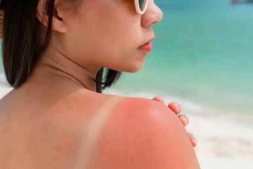5 cách bảo vệ da và chữa cháy nắng