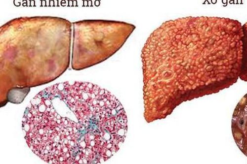 Món ăn bài thuốc tốt cho người bệnh gan nhiễm mỡ