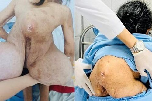 Hai lần phẫu thuật cắt bỏ khối u khổng lồ cho bệnh nhân 62 tuổi