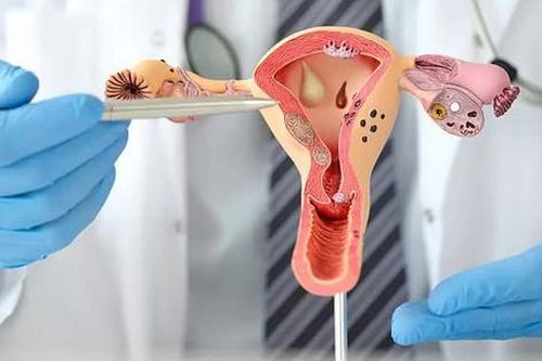 Các bài thể dục cải thiện biểu hiện của hội chứng buồng trứng đa nang