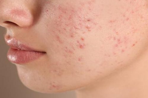 Điều trị mụn trứng cá dùng thuốc gì?