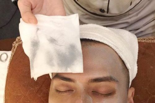 Hút chì thải độc cho da: 'Chiêu trò' câu khách!