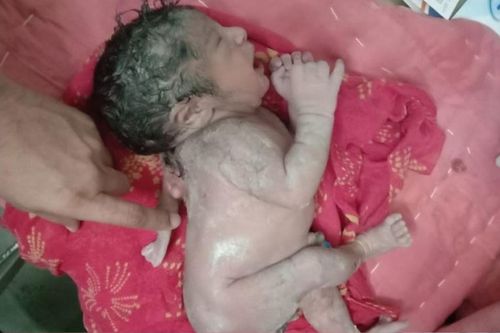 Em bé chào đời với cánh tay thứ ba mọc thêm ở sau lưng cực kỳ hiếm gặp