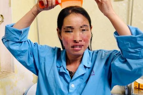 Mất tiền đi cấy tóc mới phát hiện bị lupus ban đỏ
