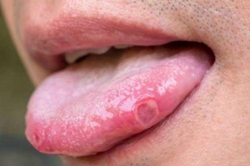 3 dấu hiệu ở lưỡi cảnh báo ung thư