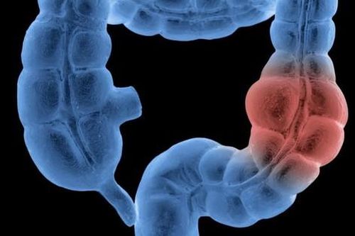 Nữ y tá 24 tuổi phát hiện ung thư đại tràng giai đoạn 3 từ 1 triệu chứng