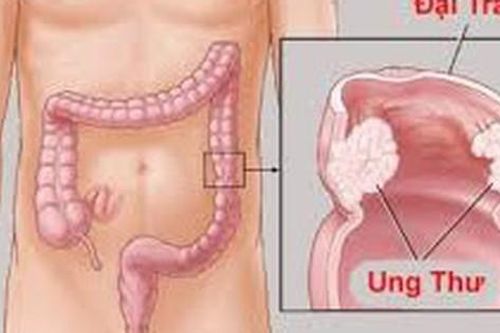 Ung thư đại tràng: Nguyên nhân, triệu chứng và điều trị