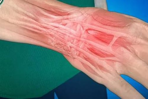 Cách xử trí khi bị bong gân cổ tay