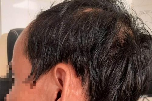 Phát hiện hàng chục con giòi làm tổ trong tai