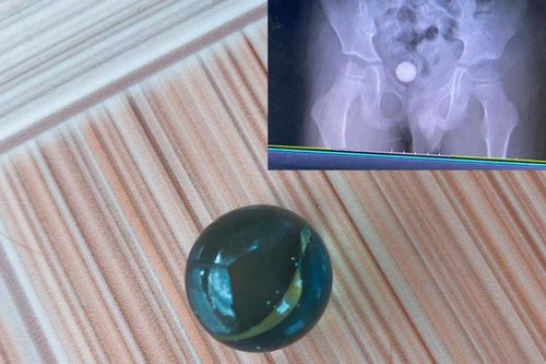 Đang chơi đùa, bé trai nhập viện khẩn vì nuốt phải thứ đồ chơi vô cùng thân thuộc tưởng như vô hại