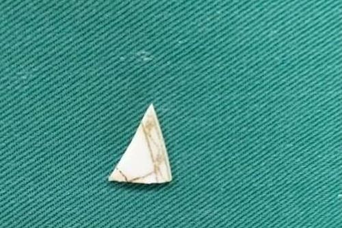 Mảnh sành sắc nhọn bị 'bỏ quên' 2 năm trong khớp gối bé 9 tuổi