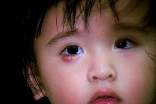 Chắp lẹo mắt có lây không?