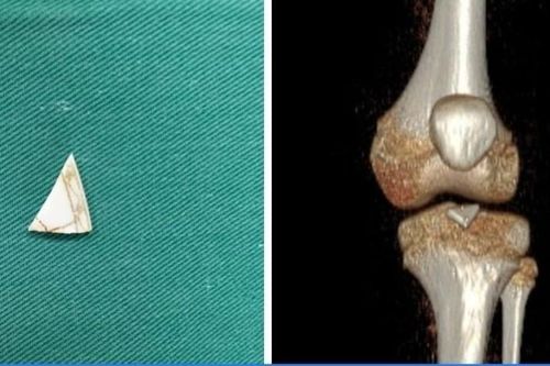 Mảnh sành sắc nhọn bị 'bỏ quên' 2 năm trong khớp gối trẻ 9 tuổi