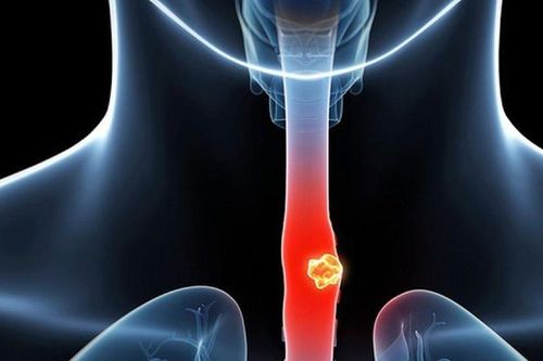 Trào ngược dạ dày thực quản có chuyển thành ung thư không?