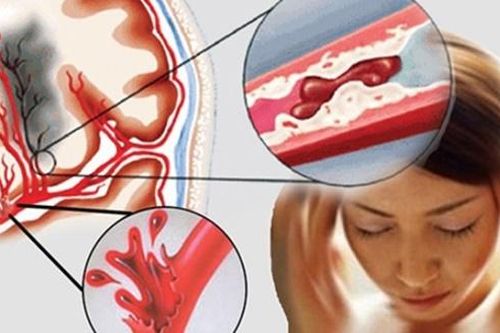 Những dấu hiệu cảnh báo mạch máu bị tắc nghẽn