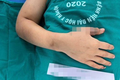 Hồi sinh ngón tay bị đứt rời cho bệnh nhi 9 tuổi