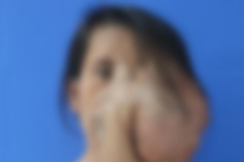 Người phụ nữ mang khối u phần đầu to bằng một cái đầu, nhãn cầu rơi ra khỏi ổ mắt