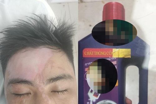 Người đàn ông bị bỏng nặng do nước thông cống