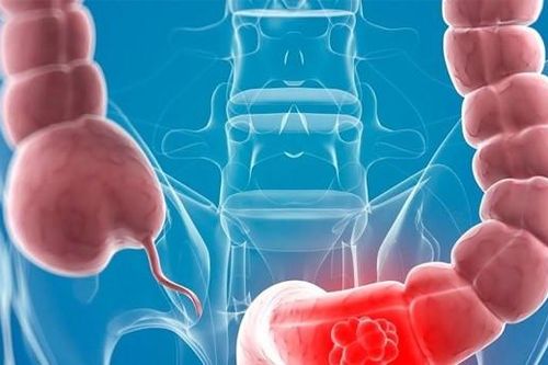 Bốn bệnh dễ bị nhầm lẫn với ung thư đại tràng