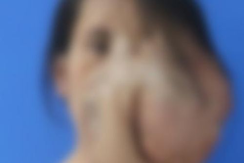 Người phụ nữ có khối u khổng lồ vùng mặt to như một chiếc đầu thứ hai