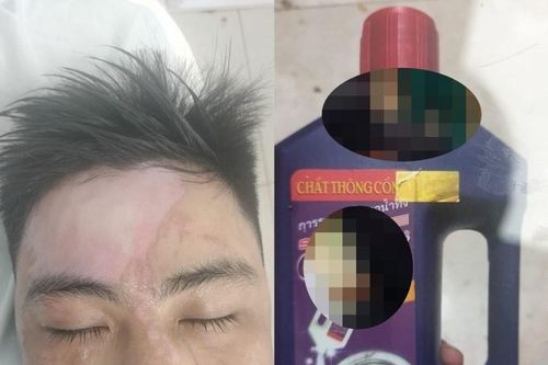 Nhiều trường hợp bỏng nặng khi sử dụng chất thông cống siêu tốc