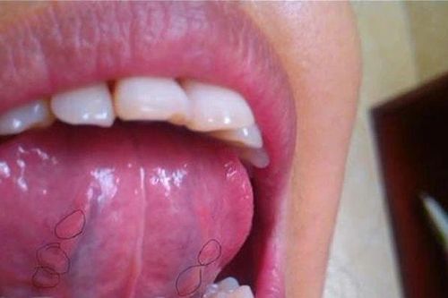 Lưỡi là 'thước đo' sức khỏe, thấy 4 dấu hiệu cảnh báo này thì đừng có chủ quan