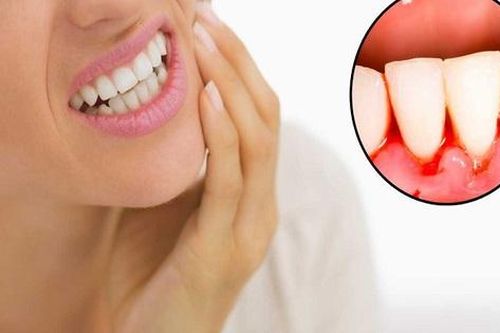 Yếu tố liên quan đến viêm lợi và hệ lụy