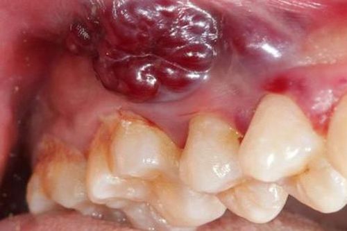 Hút thuốc, uống rượu nhiều năm, cụ ông được phát hiện ung thư lợi, khối u lấp đầy miệng không thể ăn uống