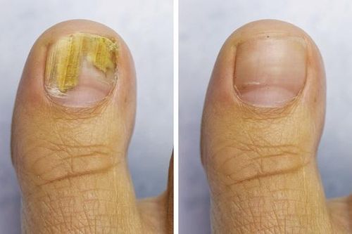 Các biện pháp phòng ngừa nấm móng vào mùa hè