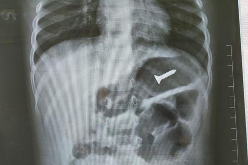 Bé 3 tuổi nuốt nhập viện khẩn vì nuốt nhầm thứ đồ nhà nào cũng có, bác sĩ cảnh báo cực kỳ nguy hiểm