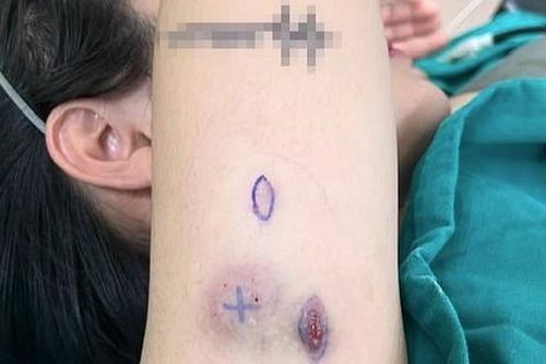 Phát hoảng vì nhiễm trùng, nổi u cục sau tiêm thuốc tiêu mỡ