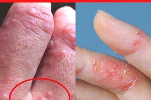 Tay chân nổi mụn nước 'ngứa như điên' gãi chán tay không hết, thử ngay cách này liền ổn!