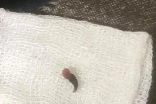 Con vắt dài 3 cm sống trong mũi người đàn ông cả tuần
