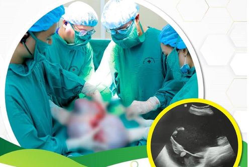 Bụng to tưởng tăng cân, bất ngờ phát hiện khối u buồng trứng