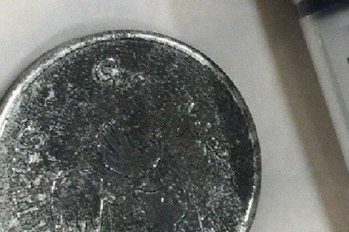Gắp đồng xu ra khỏi thực quản cháu bé 10 tuổi