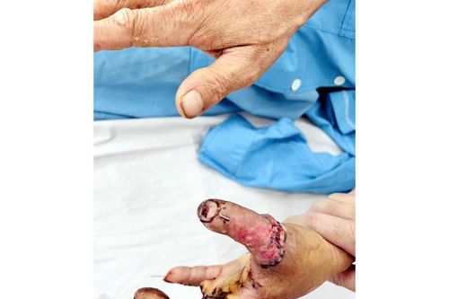 Phẫu thuật thành công ngón tay bị đứt lìa của một bệnh nhân