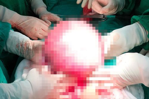 Mổ lấy khối u xơ tử cung 'khủng' cho bệnh nhân 23 tuổi