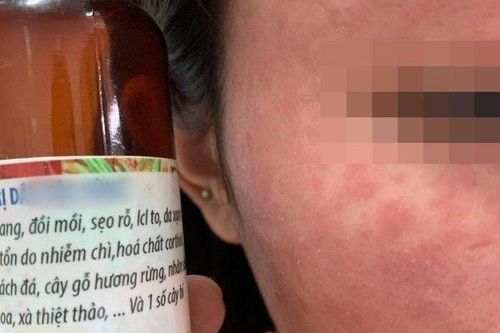 Mê làm đẹp bằng cách lột da, thiếu nữ Hà thành nhận kết đắng