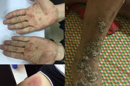 Ngứa do nhiễm ký sinh trùng từ thú cưng, nhiều người lầm tưởng là bệnh da liễu