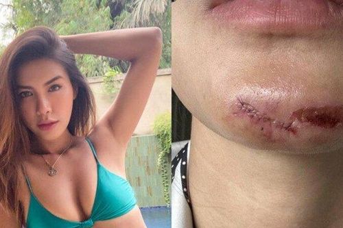 Minh Tú gặp tai nạn ở phim trường, nhập viện khâu 10 mũi