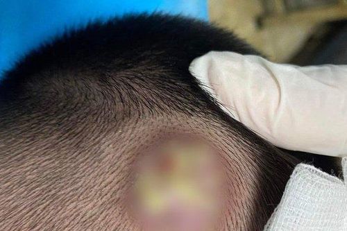 Hai chị em bị bệnh lạ ở vùng da đầu do lây nhiễm từ thú cưng