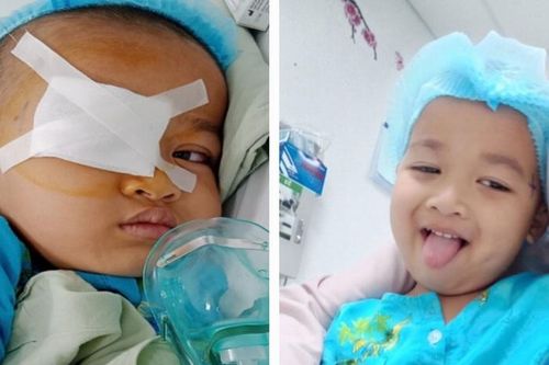 Bị kéo đập vào mắt, bé 4 tuổi bị rách giác mạc, vỡ thủy tinh thể