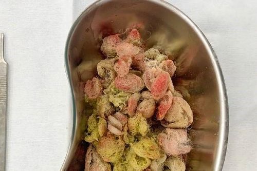 Bé gái 4 tuổi bị tắc ruột do ăn bông gòn trong ruột gấu bông