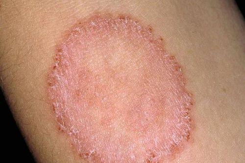 Bệnh hắc lào: Nguyên nhân và cách phòng ngừa