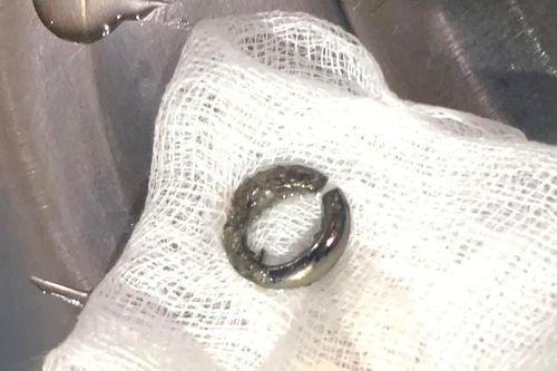 Lấy móc khóa trong bụng bé trai 27 tháng tuổi