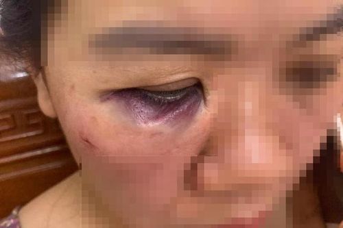 Diễn biến mới vụ nam nhân viên điện lực Hà Tĩnh đánh nữ đồng nghiệp